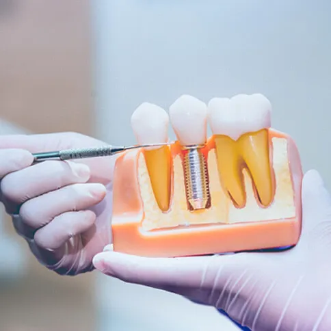 Dentist explaining single tooth implant components to patient