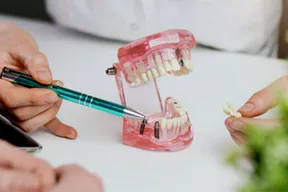 Dental implant illustration showing titanium post integrated with jawbone