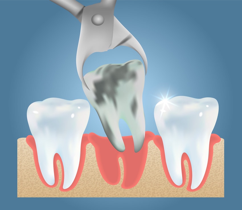 Tooth Extraction