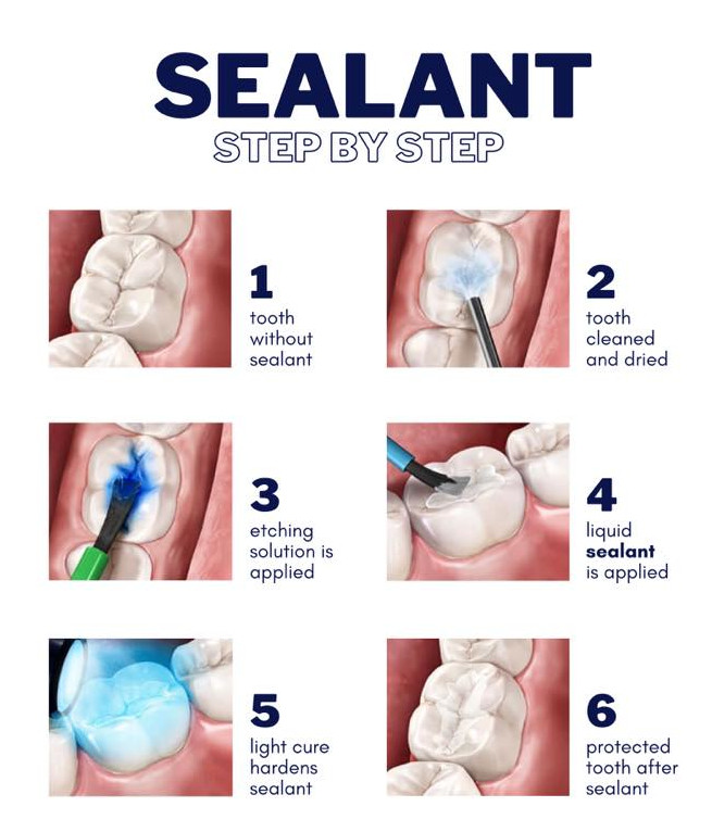 dental sealants