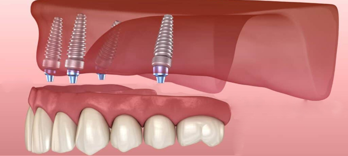Full-arch implant-supported teeth