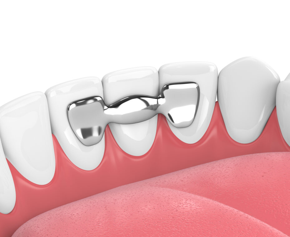 Dental Bridge image