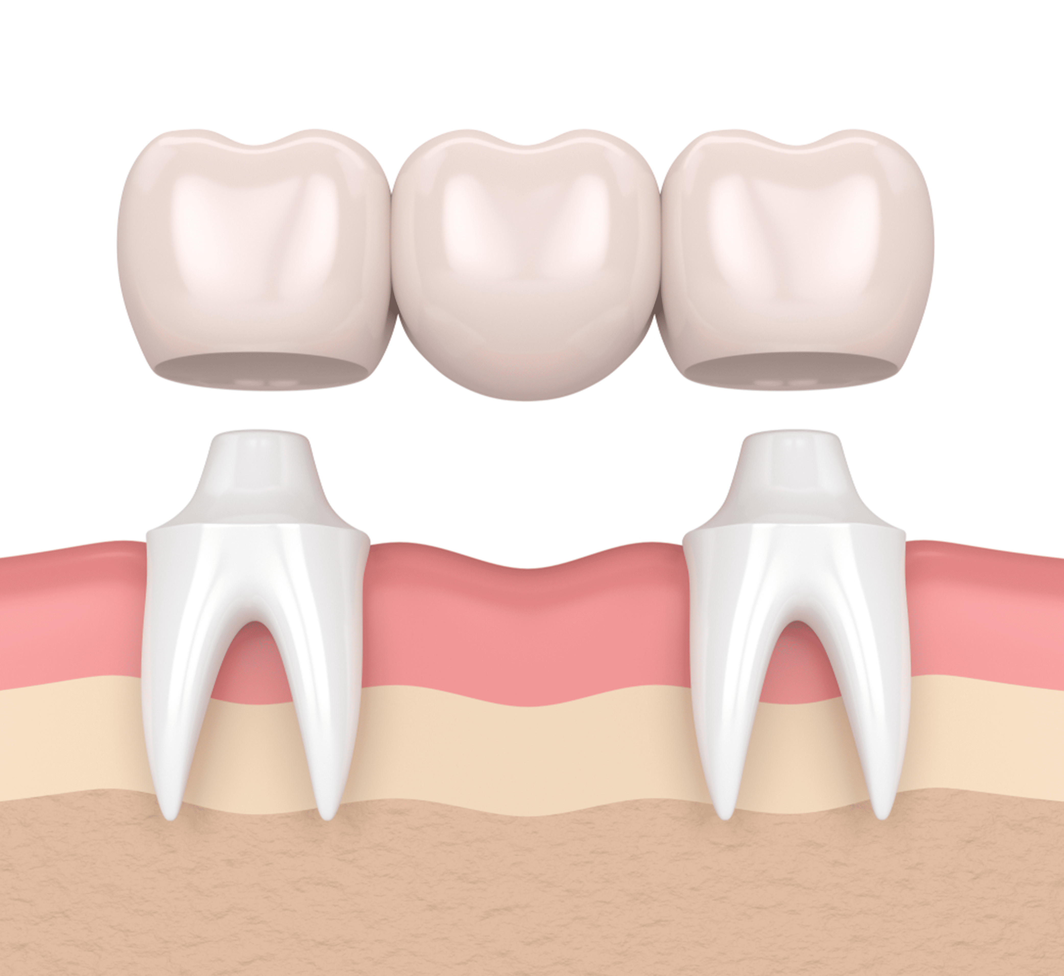 dental bridge