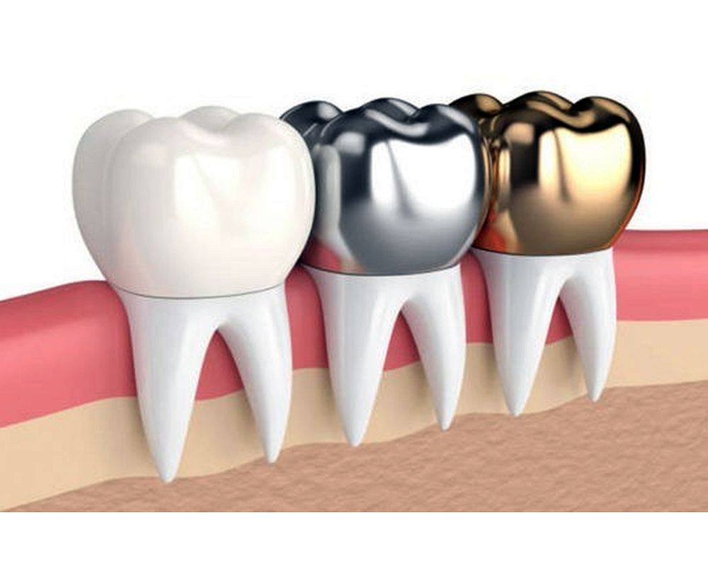 dental crowns