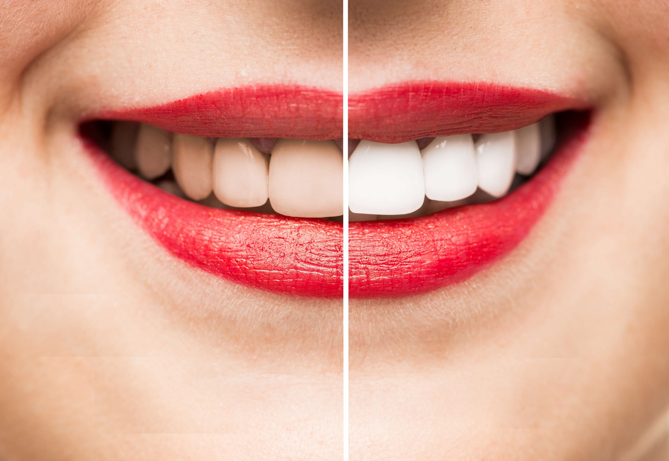 Teeth Whitening before / after