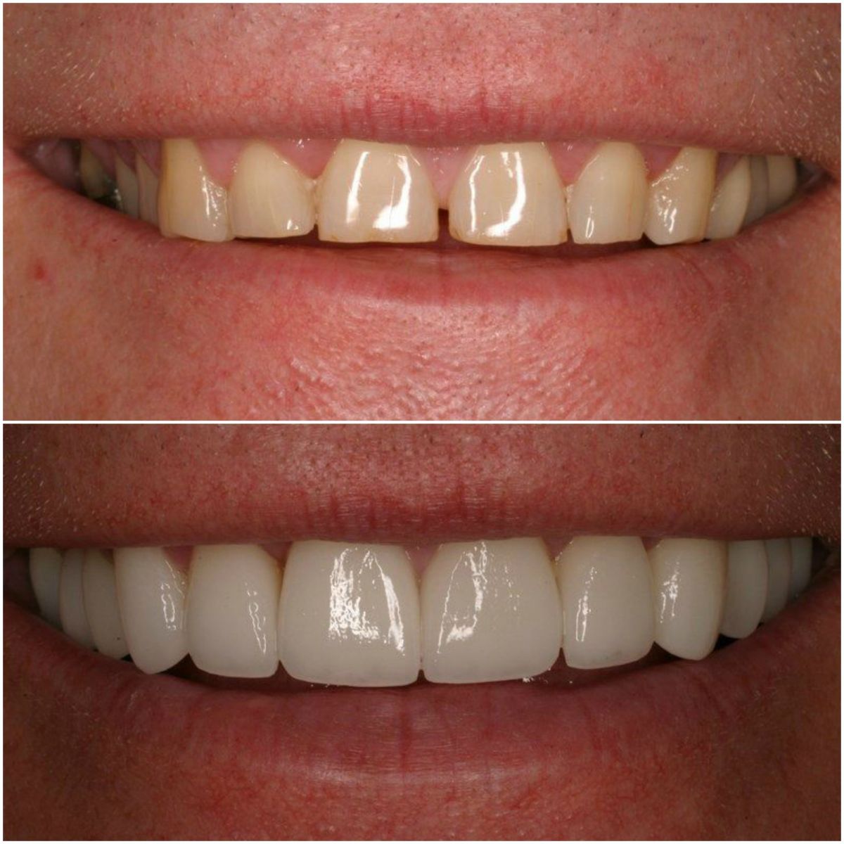 Veneers Before after image