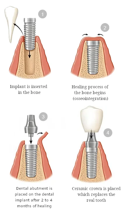 implant sequence