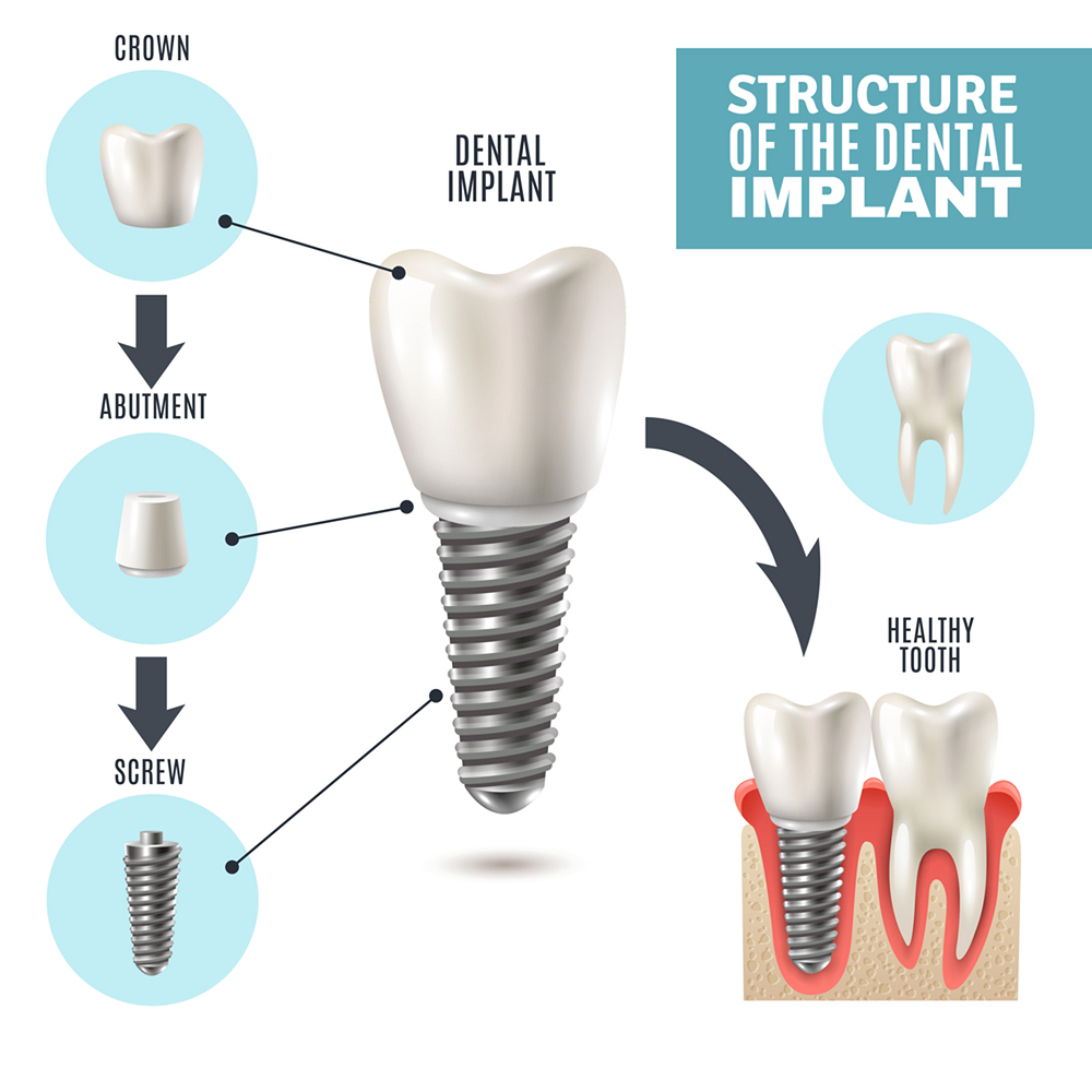 Dental Implant Structure