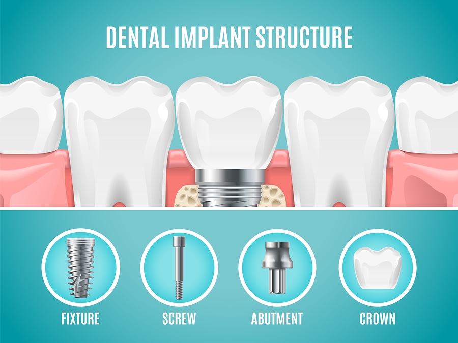 implant structure