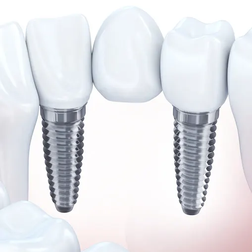 Implant assisted bridge