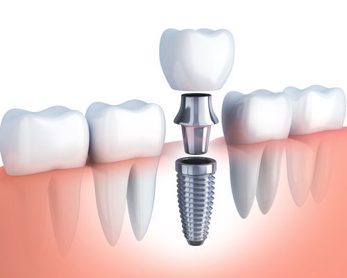 missing teeth replacement