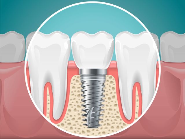 missing teeth replacement