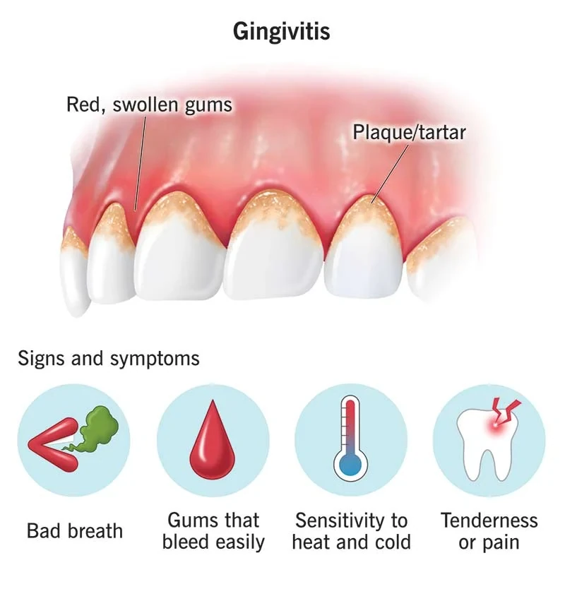 Signs and symptoms of periodontal disease