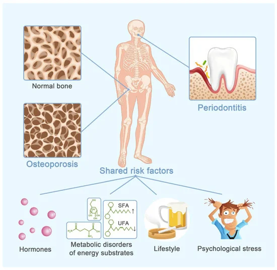 osteoporosis image