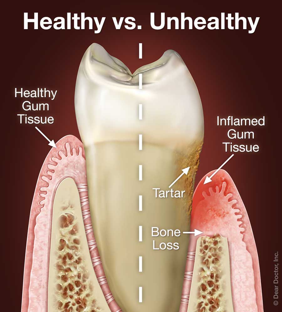 periodontal disease