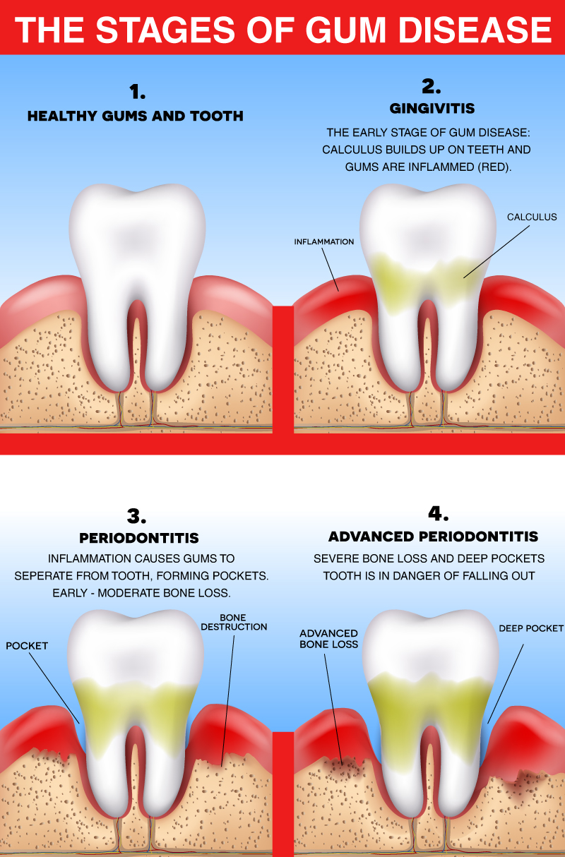 Stages of Gum Disease