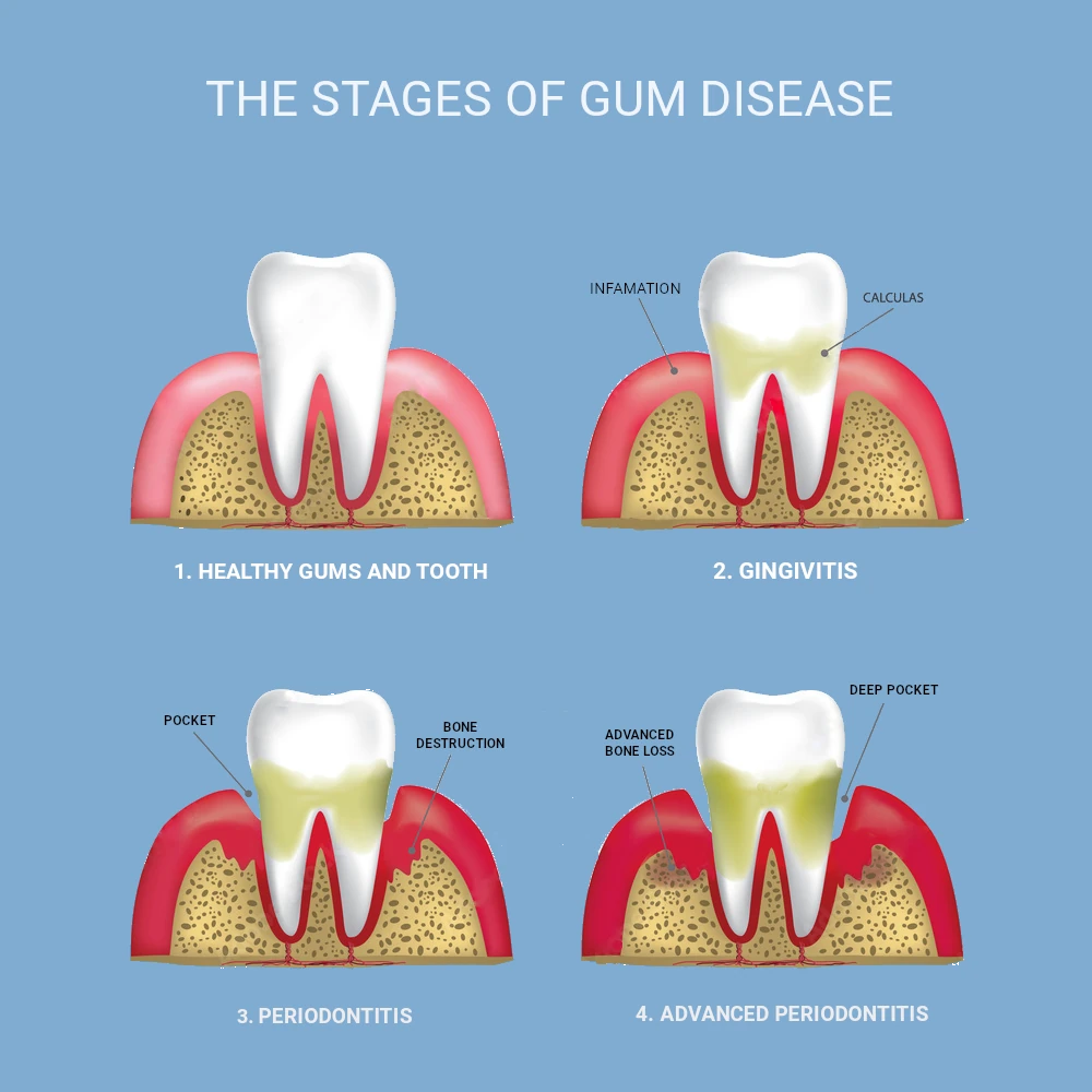 stages of periodontist disease