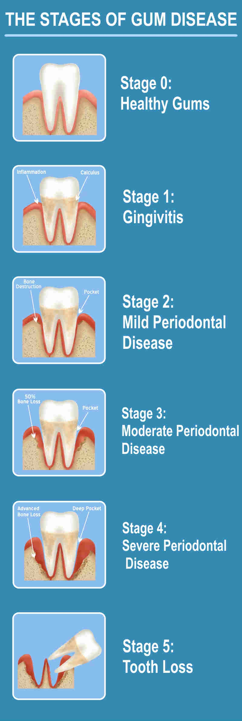 stages of periodontal disease image