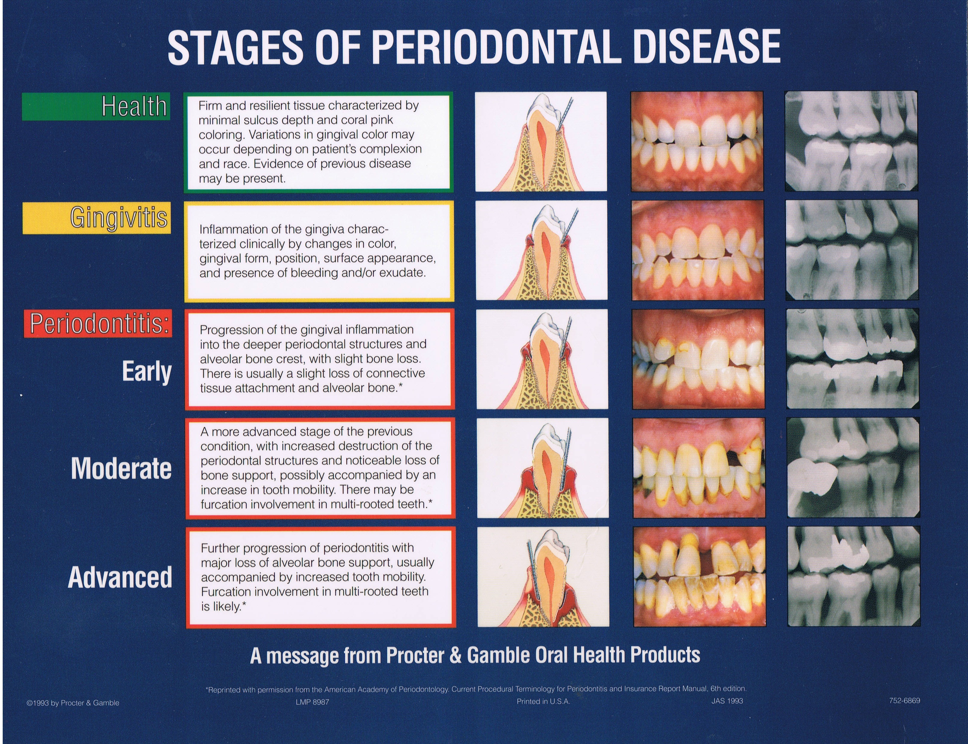 Types of periodontal disease