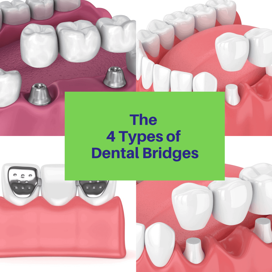 4 types of bridges