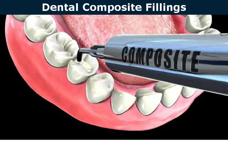 composite fillings