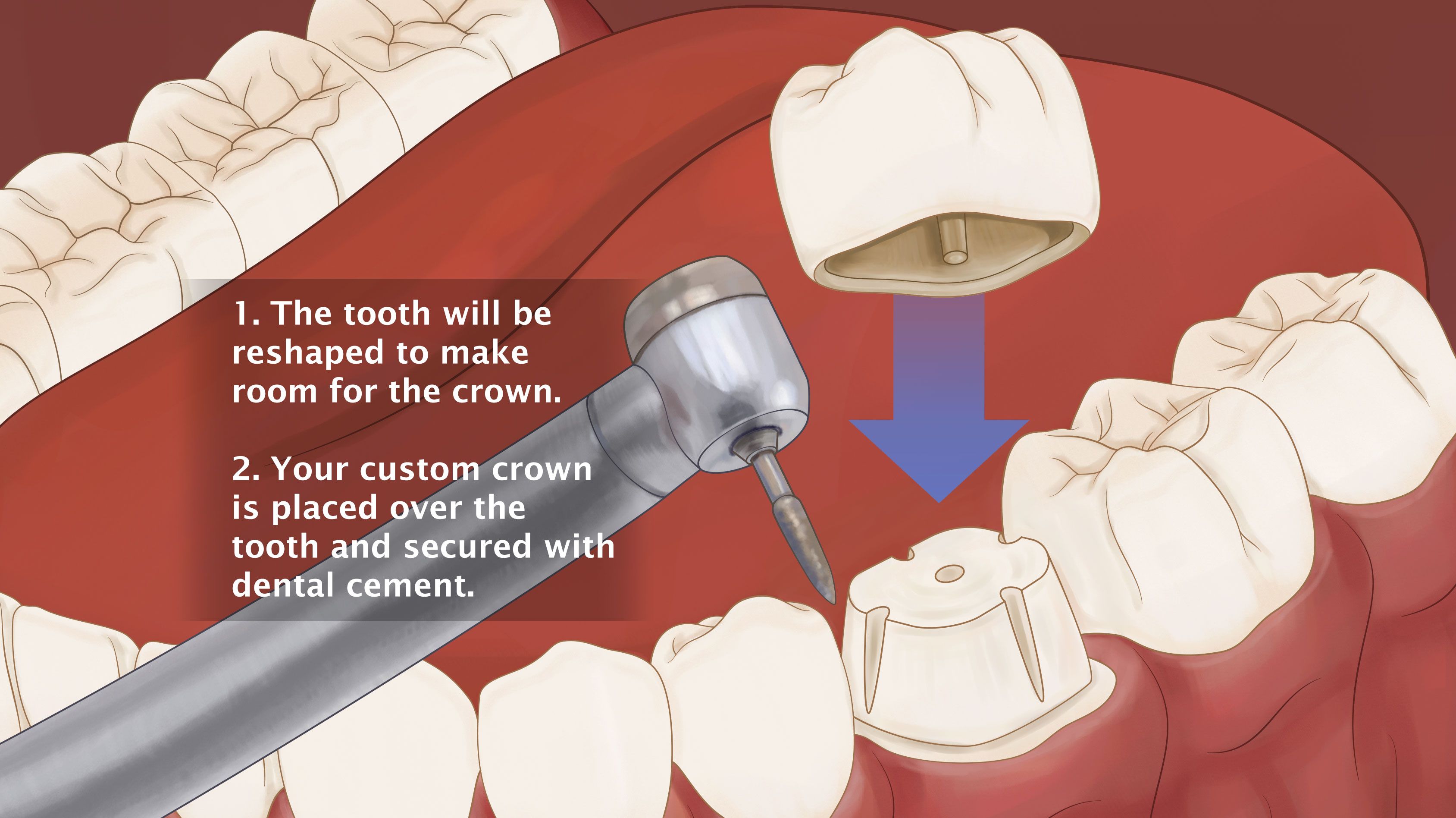 dental crown procedure