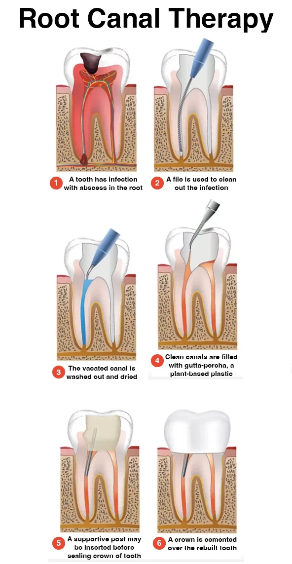 Root Canal procedure