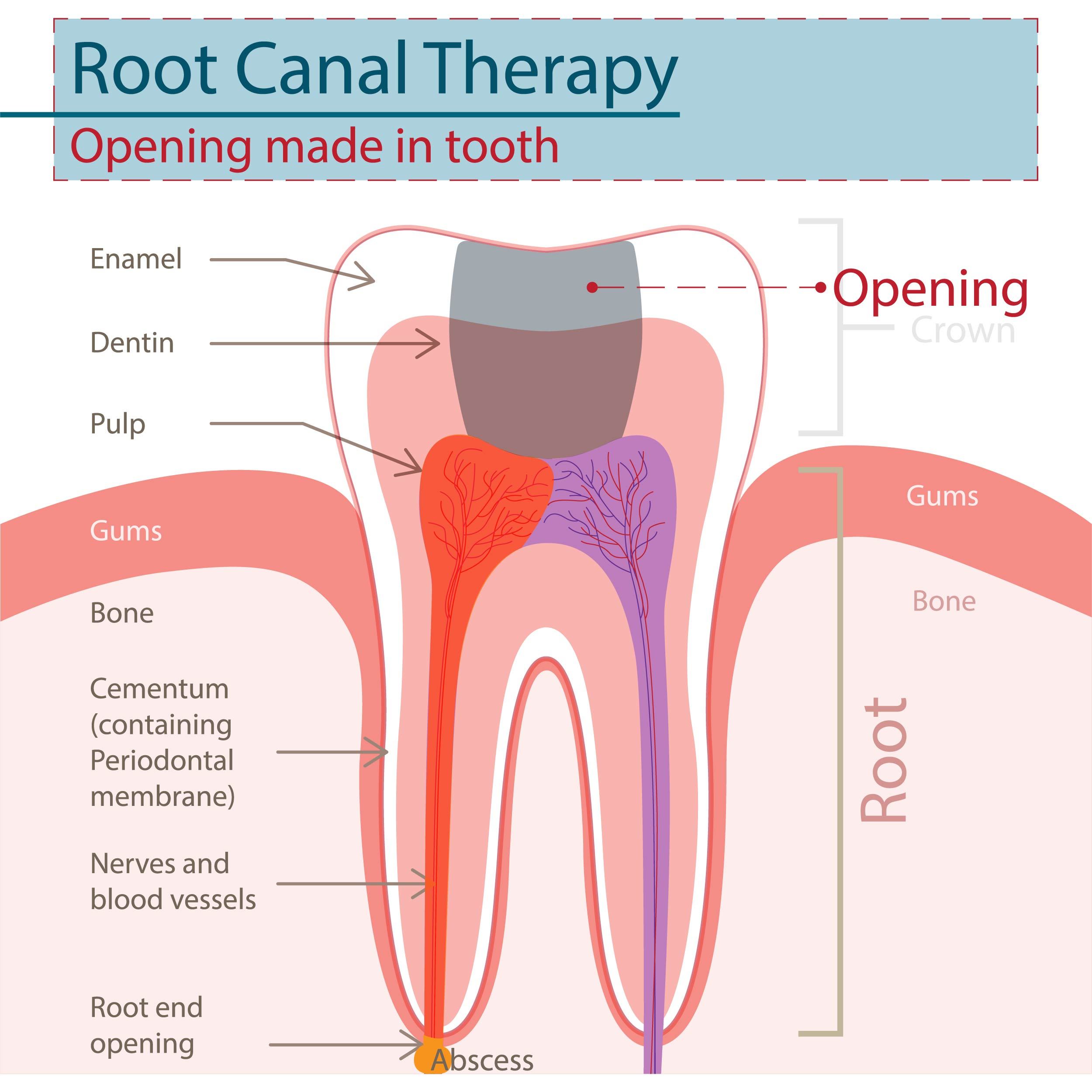 root canal therapy