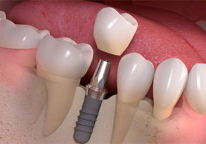 Implant Dentistry Image