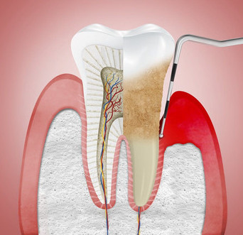 Periodontal Disease Dentistry Image