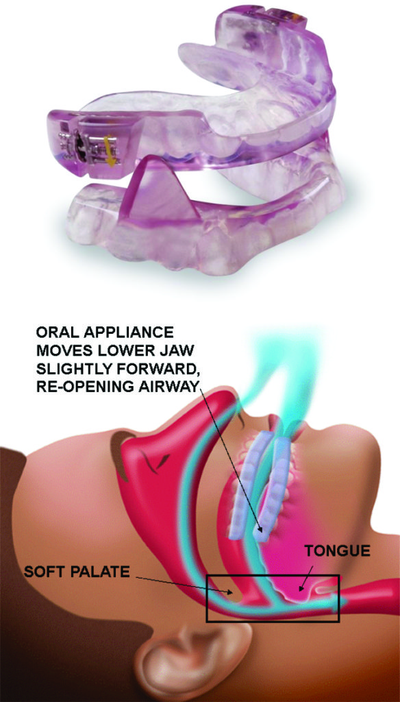 Sleep apnea appliance